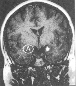 Attivazione dell’amigdala umana durante il condizionamento alla paura.  L’incremento della attività neurale è indicato dal punto bianco sul lato destro Estratta da LeDoux, Il Sé Sinaptico, Cortina, 2002, p. 304